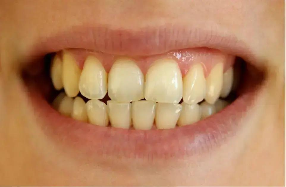 Sete Causas Surpreendentes do Amarelamento dos Dentes e como Evitar