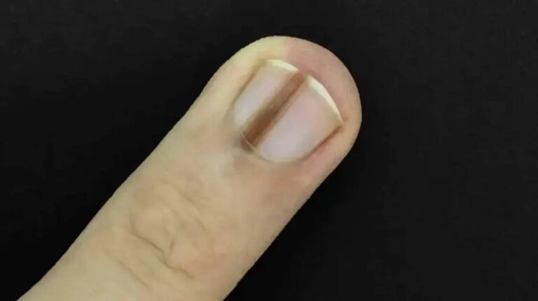 Como uma foto no Reddit salvou um homem ao alertar sobre saúde das unhas