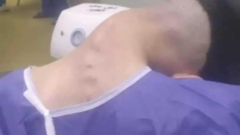 Síndrome da Cabeça Caída: O Impacto do Abuso de Drogas no Corpo