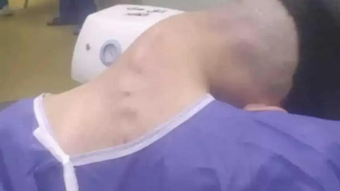 Síndrome da Cabeça Caída: O Impacto do Abuso de Drogas no Corpo