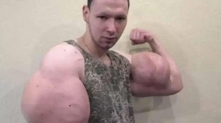 Popeye russo: a transformação impressionante após cirurgia nos braços